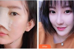 永州新唯美整形美容醫(yī)院劉尚海整形價格表附鼻部綜合案例展示