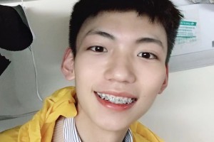 上海九院口腔科邱蔚六牙齒矯正果太好了附果圖和價目表