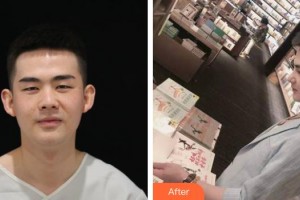 永州市皮膚病醫(yī)院醫(yī)療美容科呂朝俊整形價格表附鼻部綜合案例展示