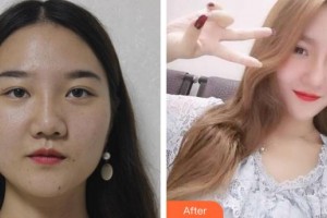 永州傾城醫(yī)療美容門診部嚴興萍整形價格表附假體隆鼻案例展示