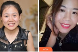 永州中南口腔醫(yī)院余芳英整形價格表附自鎖托槽矯正案例展示