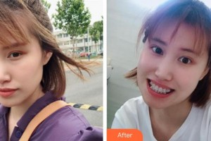 永州中南口腔醫(yī)院馬賀整形價格表附金屬托槽矯正案例展示