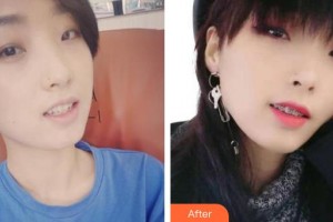 永州國斌口腔門診部劉阿寶整形價格表附金屬托槽矯正案例展示