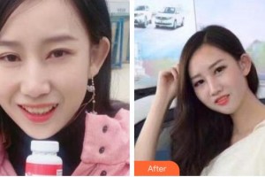 永州國斌口腔門診部唐穎文整形價格表附牙齒隱形矯正案例展示