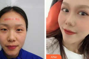 永州愛爾眼科醫(yī)院伍俊整形價格表附切開雙眼皮案例展示