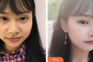 永州愛爾眼科醫(yī)院黃海濤整形價格表附切開雙眼皮案例展示