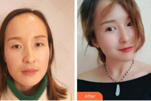 永州愛爾眼科醫(yī)院李格明整形價格表附眼部綜合案例展示