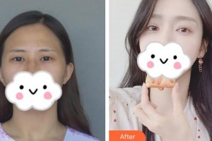 永州愛爾眼科醫(yī)院張艷整形價格表附眼部綜合案例展示