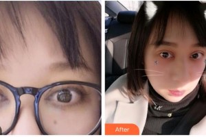 永州愛爾眼科醫(yī)院胡艷玲整形價格表附外切祛眼袋案例展示