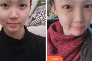 永州市第一人民醫(yī)院眼科魏蓉整形價格表附眼部綜合案例展示