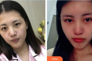 順德愛爾眼科醫(yī)院霍敏灼整形價格表附埋線雙眼皮案例展示