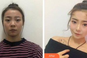 漢中人民醫(yī)院整形顯微外科楊陽整形價(jià)格表附埋線提升案例展示