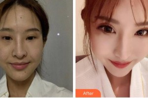 漢中市中心醫(yī)院燒傷整形美容外科李金友整形價(jià)格表附埋線(xiàn)提升案例展示