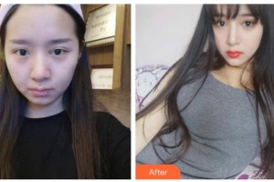 漢中華美醫(yī)療美容診所王巨曠整形價(jià)格表附埋線(xiàn)提升案例展示