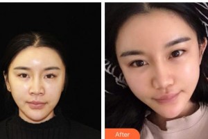 漢中韓美整形美容醫(yī)院常雙模整形價(jià)格表附埋線(xiàn)提升案例展示