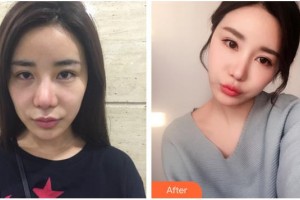 漢中南方醫(yī)療美容診所李雪整形價(jià)格表附埋線(xiàn)提升案例展示