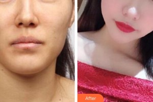 漢中韓美整形美容醫(yī)院李峻福整形價(jià)格表附埋線(xiàn)提升案例展示