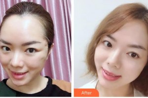 漢中韓美整形美容醫(yī)院李昭迎整形價(jià)格表附埋線提升案例展示