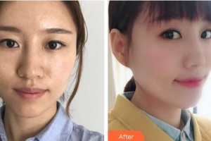 漢中天漢伊美醫(yī)療美容門診部劉思學(xué)整形價(jià)格表附埋線提升案例展示