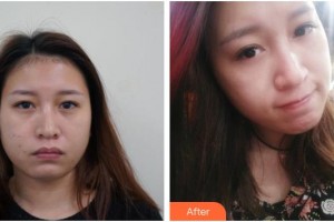 漢中韓美整形美容醫(yī)院閔慶植整形價(jià)格表附埋線提升案例展示