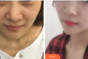 漢中天漢伊美醫(yī)療美容門(mén)診部潘會(huì)章整形價(jià)格表附埋線(xiàn)提升案例展示