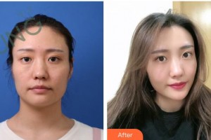 漢中祥瑞海天醫(yī)療美容診所馬嫣旎整形價(jià)格表附埋線(xiàn)提升案例展示