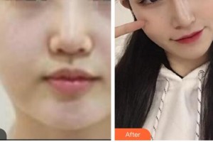 漢中祥瑞海天醫(yī)療美容診所高玉慶整形價(jià)格表附埋線(xiàn)提升案例展示