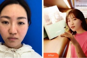 漢中職業(yè)技術(shù)學(xué)院附屬醫(yī)院眼科方彤整形價(jià)格表附埋線(xiàn)提升案例展示