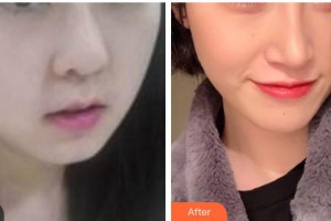 漢中天漢伊美醫(yī)療美容門(mén)診部王伶霄整形價(jià)格表附埋線(xiàn)提升案例展示