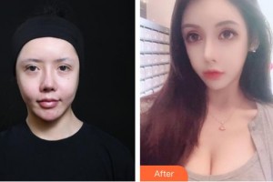 漢中南方醫(yī)療美容診所孫亞莉整形價(jià)格表附熱拉提案例展示