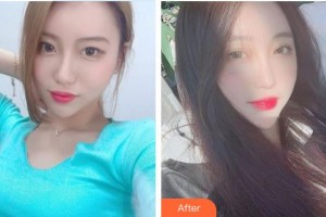 榆林婦產(chǎn)專(zhuān)科醫(yī)院韓式整形美容中心宋寶強(qiáng)整形價(jià)格表附切開(kāi)雙眼皮案例展示