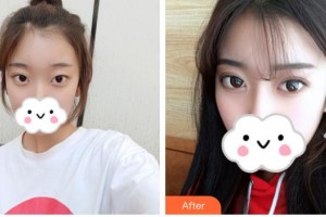 榆林醫(yī)專(zhuān)附屬醫(yī)院醫(yī)學(xué)整形美容中心周亞芹整形價(jià)格表附眼部綜合案例展示