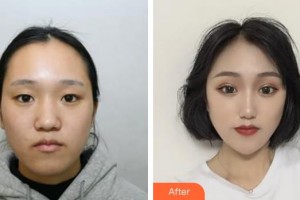 榆林博愛(ài)醫(yī)院整形美容中心蔡民銀整形價(jià)格表附眼部綜合案例展示