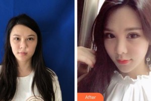 榆林市第一醫(yī)院燒傷整形與皮膚外科席云峰整形價(jià)格表附切開(kāi)雙眼皮例展示