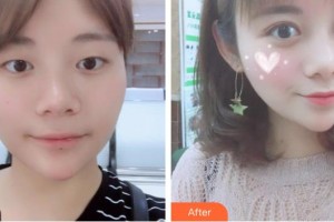 榆林愛(ài)爾眼科醫(yī)院高利梅整形價(jià)格表附切開(kāi)雙眼皮案例展示