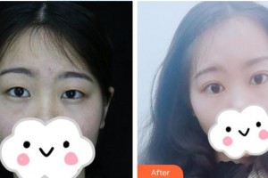 榆林市中醫(yī)醫(yī)院眼科醫(yī)院李武軍整形價(jià)格表附切開(kāi)雙眼皮案例展示