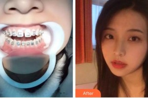 榆林市第四醫(yī)院口腔科馮毅整形價(jià)格表附隱形托槽矯正案例展示