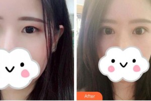 榆林市中醫(yī)醫(yī)院眼科醫(yī)院丁艷林整形價(jià)格表附眼部綜合案例展示