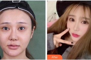 安康希顏醫(yī)療美容診所高景恒整形價(jià)格表附埋線(xiàn)提升案例展示