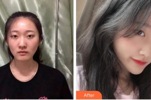 安康希顏醫(yī)療美容診所王奇整形價(jià)格表附熱瑪吉案例展示