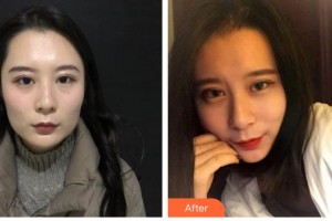 武安安康醫(yī)院整形美容中心李連貴整形價(jià)格表附埋線(xiàn)提升案例展示