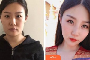 安康希顏醫(yī)療美容診所何云虎整形價(jià)格表附埋線(xiàn)提升案例展示