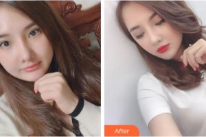 安康永秀醫(yī)療美容醫(yī)院劉祥整形價(jià)格表附埋線(xiàn)提升案例展示