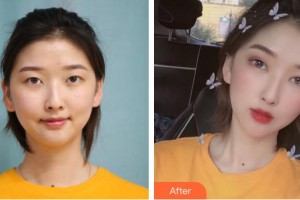 安康市人民醫(yī)院整形外科祖冬梅整形價(jià)格表附眼部綜合案例展示