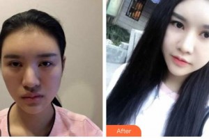 安康愛(ài)爾眼科醫(yī)院龔力力整形價(jià)格表附眼部綜合案例展示