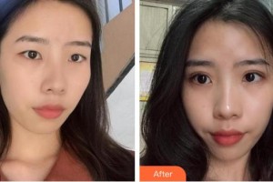 安康希顏醫(yī)療美容診所楊志榮整形價(jià)格表附埋線(xiàn)雙眼皮案例展示