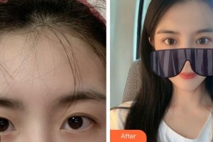 安康愛(ài)爾眼科醫(yī)院曾忠玲整形價(jià)格表附眼部綜合案例展示