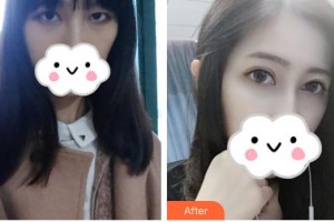 安康愛(ài)爾眼科醫(yī)院楊積文整形價(jià)格表附眼部綜合案例展示