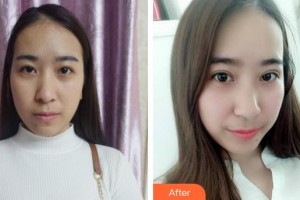 安康愛(ài)爾眼科醫(yī)院吳剛整形價(jià)格表附切開(kāi)雙眼皮案例展示