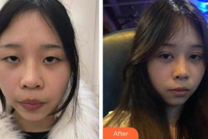 慶陽華美醫(yī)療美容診所劉懷樸整形價格表附切開雙眼皮案例展示